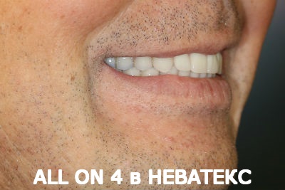 all on 4 фото после в неватекс all on 4 фото после